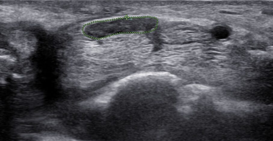 Carpal Tunnel Syndrome with Co-existing Pathology