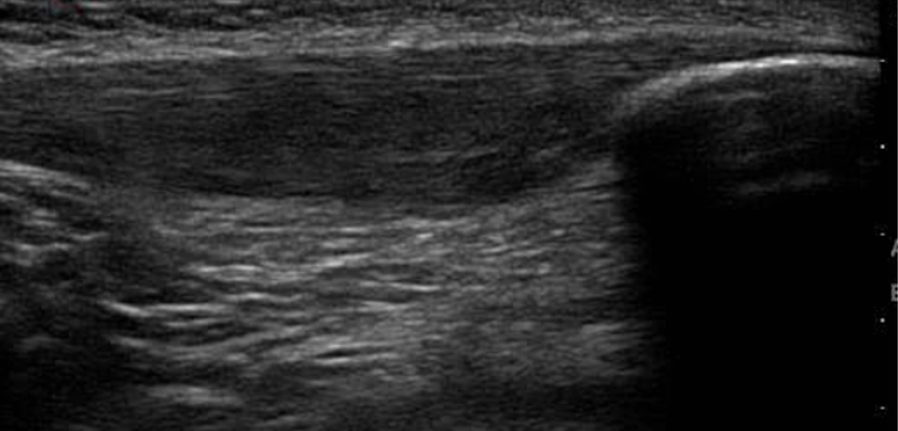 Reactive Tendon Hypertrophy: A Rare Complication of Tendon Fenestration and PRP Injection