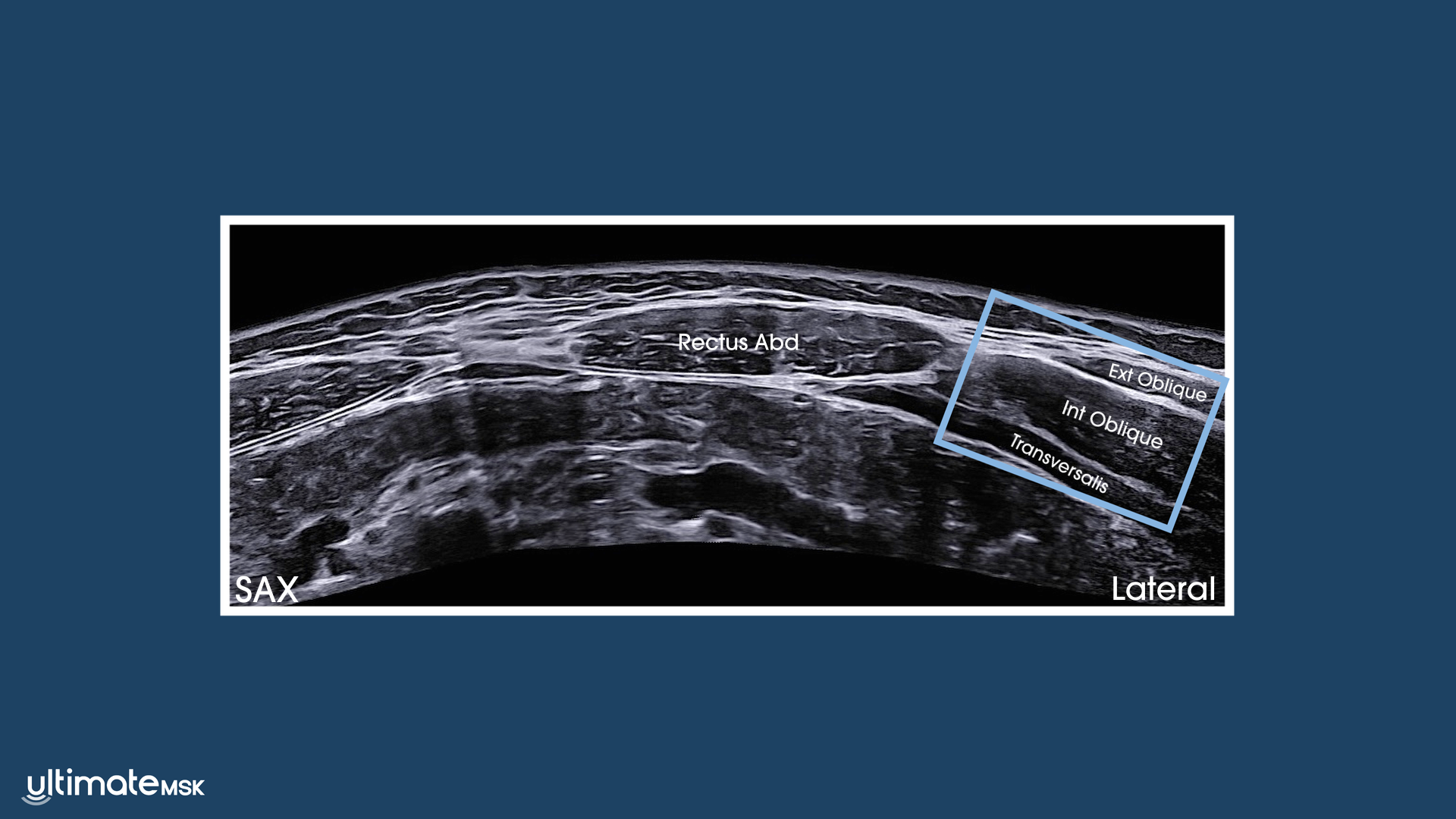 15 year-old with a snapping internal oblique muscle