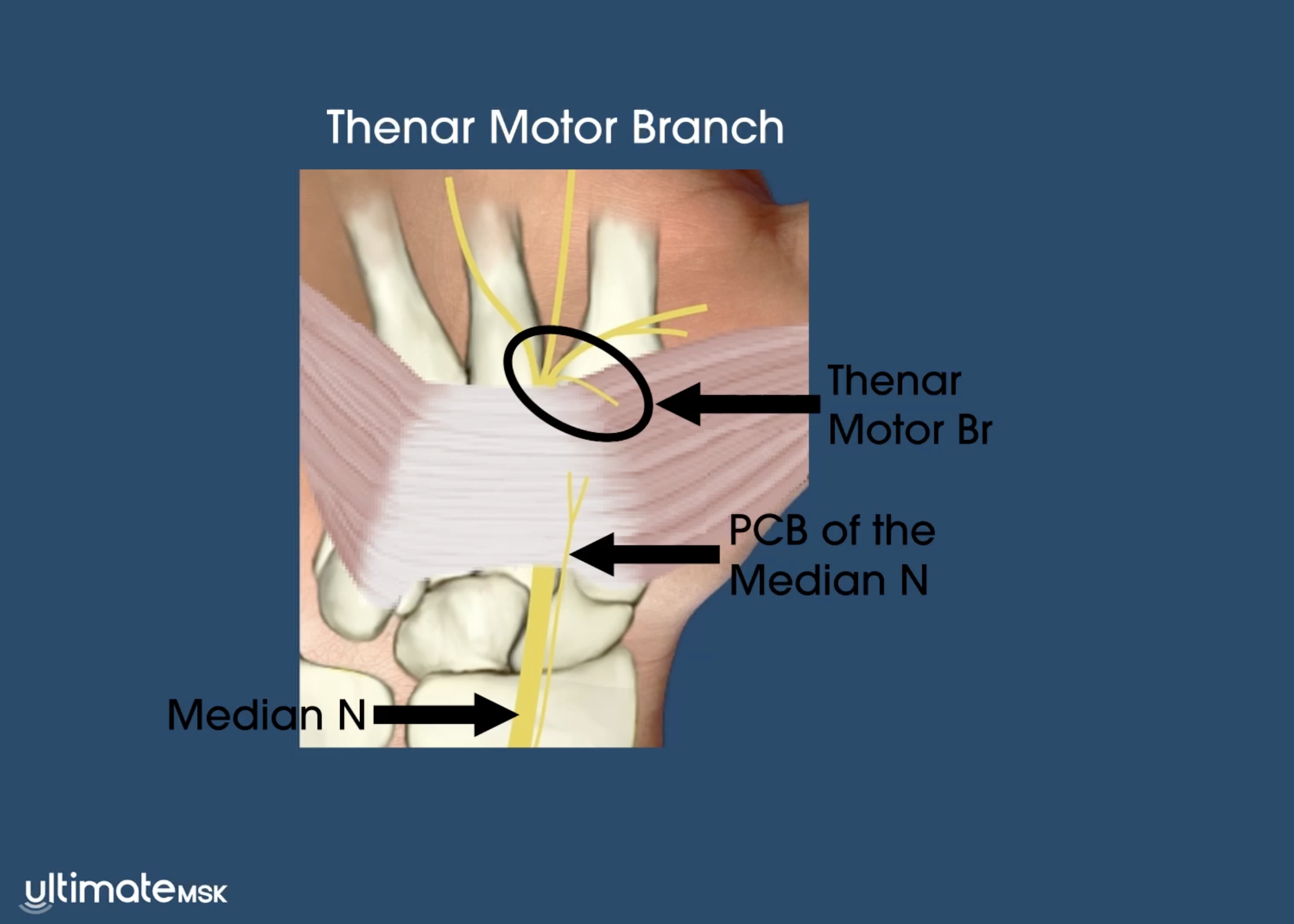 Imaging the Thenar Motor Branch