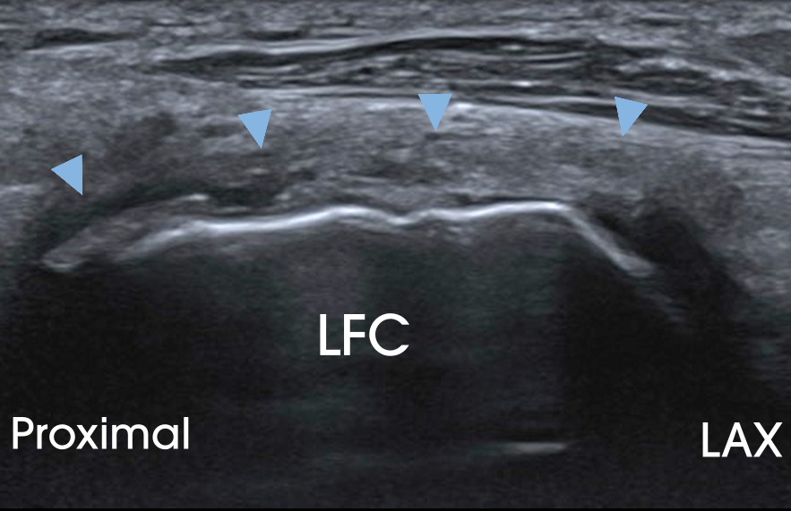 Posterolateral Knee Pain