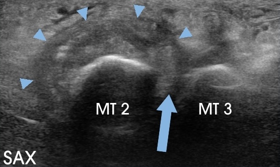 Follow-up to 2nd MTP Joint Osteoarthosis Mimicking an Interdigital Neuroma