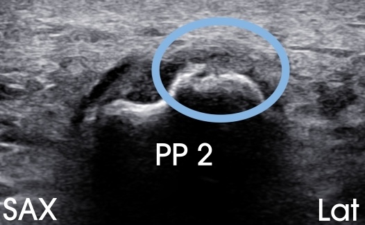 52-year-old with pain beneath the 2nd MTP joint