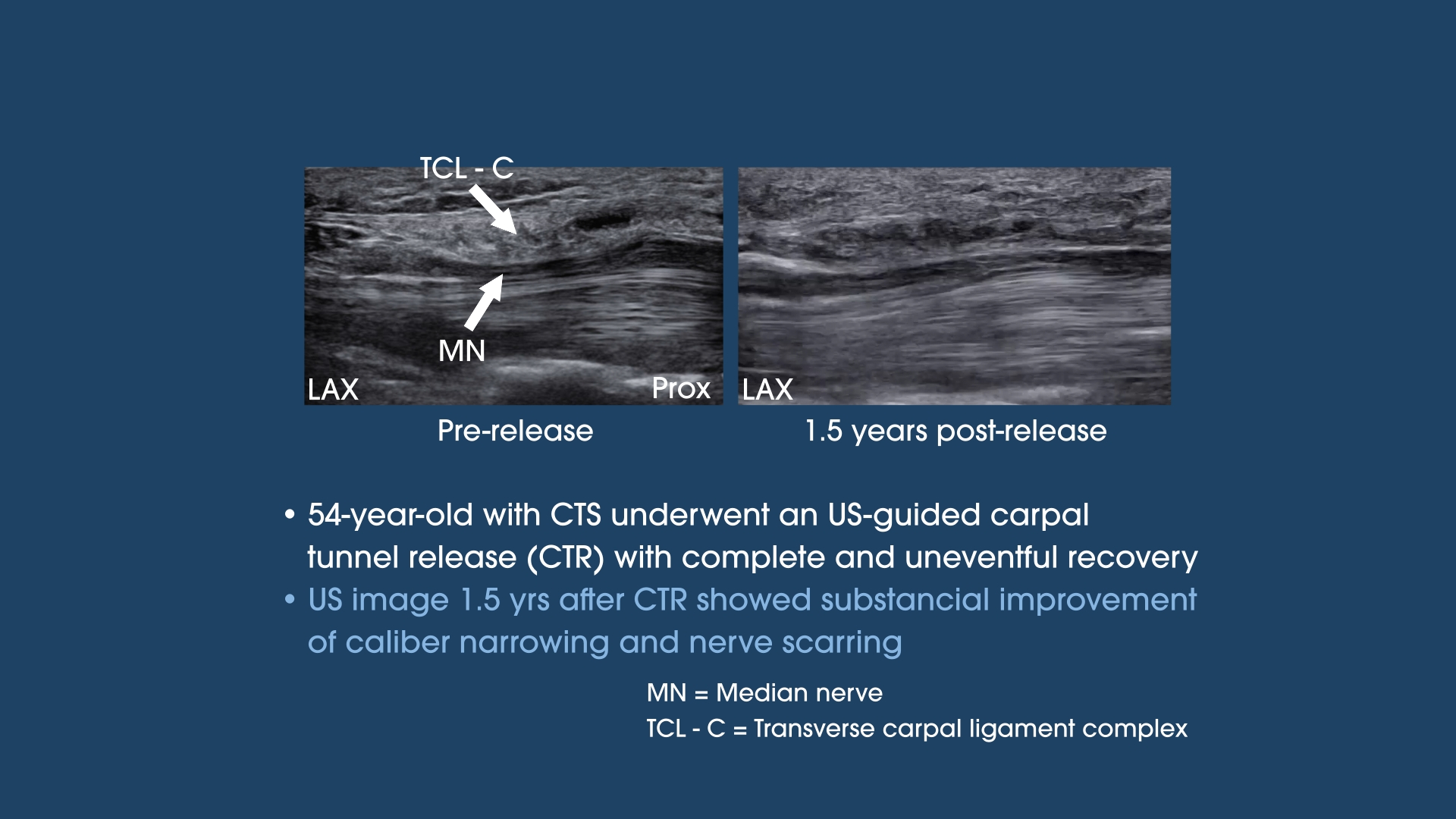 Median Nerve Changes after a Carpal Tunnel Release