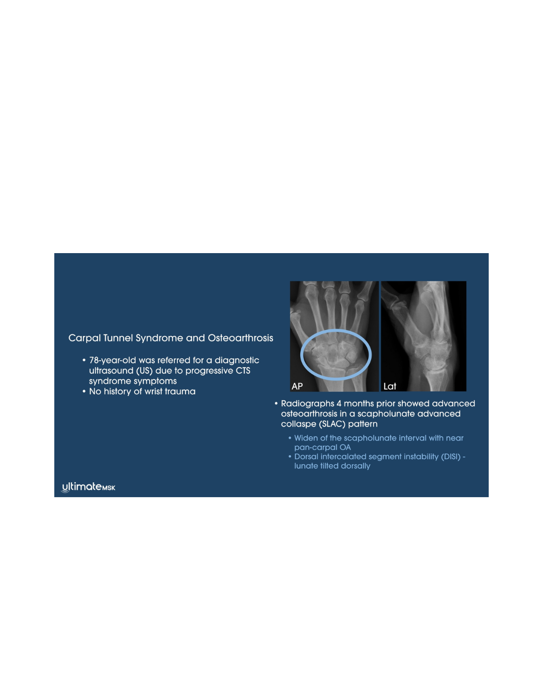 Carpal Tunnel Syndrome and Osteoarthrosis