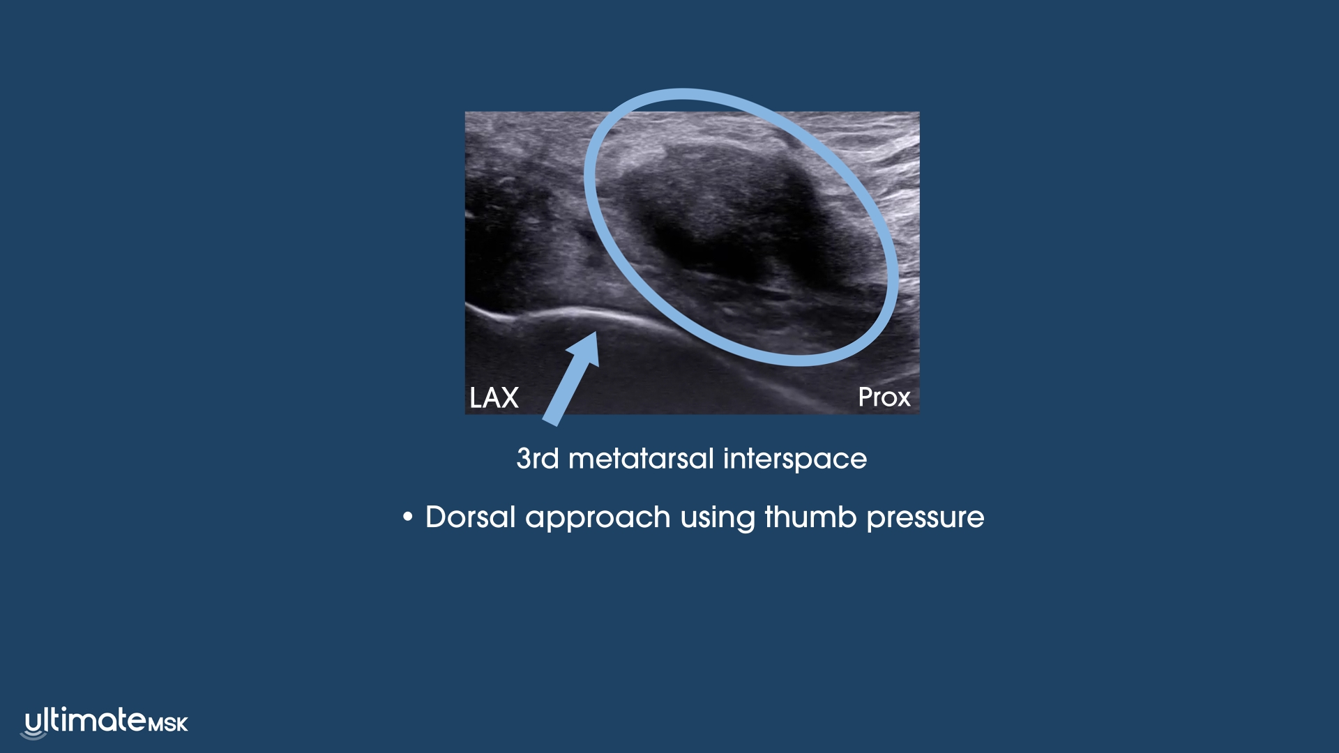 Morton’s Neuroma
