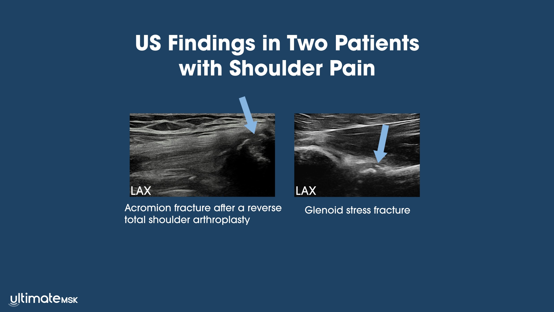 Ultrasound Detection of Two Unexpected Shoulder Fractures